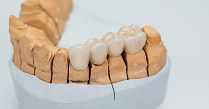 A dental bridge on a mouth mold