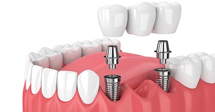 Digital image of an implant bridge